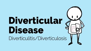 Diverticular Disease  Diverticulitis  Gastrointestinal Society [upl. by Aurilia510]