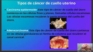 CANCER CERVICO UTERINO QBP LUCERO GUTIERREZ TARANGO 6564329496 [upl. by Fiann]