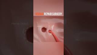 Inguinal Hernia Repair Surgery [upl. by Iak2]