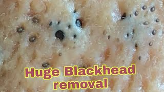 Huge Blackhead removal tiktok [upl. by Datnow16]