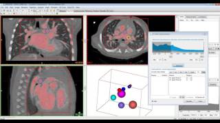 Tutorial Mimics Innovation Suite  CT Heart Automated Segmentation [upl. by Alexandrina473]