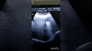 liver hydrated cyst liver ultrasound pocus cystic radiologytechnologist medical doctor [upl. by Annoyi]