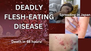 Deadly FleshEating Disease  STSS  News  What you need to know [upl. by Aticnemrac885]