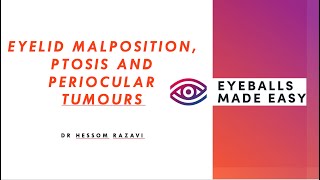 Eyelid malposition ptosis and periocular tumours [upl. by Aynatahs]