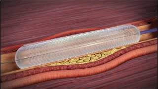 What is a Coronary Angioplasty [upl. by Anastasius]