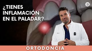 ¿Tienes INFLAMACIÓN en el PALADAR superior [upl. by Llemart]