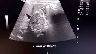 Ultrasound cases POSITIVE Hypertrophic Pyloric Stenosis  pediatric sonography [upl. by Somerset206]