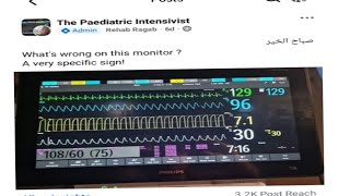 whats wrong in this monitor Dr Rehab Ragab Elseidy Capnogram capnography [upl. by Clintock]