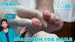 Ingrown ToenailΕίσφρυση όνυχος callus κεντροποδιου footcare podologos podiatrist podiatry [upl. by Sirromaj]