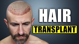 I Went to Bosley for a Hair Transplant [upl. by Fons]