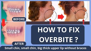 HOW TO FIX OVERBITE  SMALL CHIN BIG THICK UPPER LIP  WITHOUT BRACES NATURALLY [upl. by Alber370]