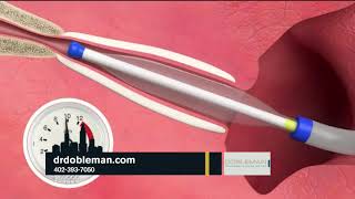 Eustachian Tube Dysfunction Balloon Treatment [upl. by Miran479]