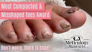 How to Pedicure Transformation the Most Compacted amp Misshapen Toenails [upl. by Jahn769]