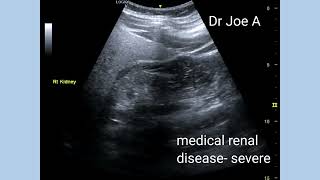 Severe medical renal disease chronic renal failure ultrasound and color Doppler video [upl. by Atselec]