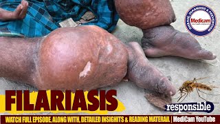 🦟Filariasis Lymphatic Filariasis Causes Symptoms and Treatment Options [upl. by Bertina]