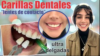 CARILLAS dentales ultra DELGADAS 🦷 Sin DESGASTAR tus DIENTES ❤️ En UNA sesión 👄 Dr SANTIAGO BURGA 3D [upl. by Nylodam811]