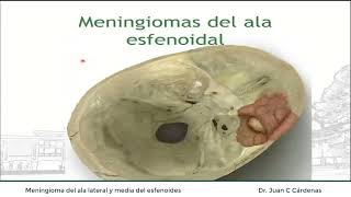 Meningioma del ala lateral y media del esfenoides [upl. by Blakeley]