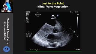 Mitral Valve vegetation [upl. by Singhal561]