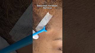 Quick and Safe Seborrheic Keratosis Removal Treatment at Dr Medispa [upl. by Randa]