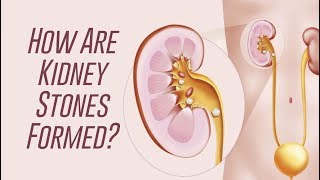 How Kidney Stones are Formed [upl. by Yehus721]