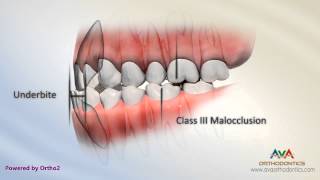 Malocclusion  Underbite or Crossbite [upl. by Rema]