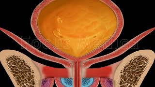 Cystometry  Animated Atlas of BPH and OAB [upl. by Lanctot]