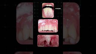 வாயில் ஏற்படும் பூஞ்சை தொற்று Oral Thrush Dr Isacc Abbas [upl. by Lotte]