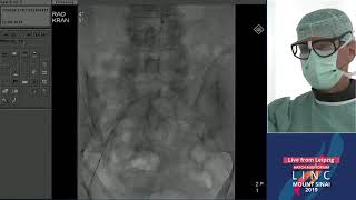 Hatch LC 3  Total Occlusion of Iliac Artery  Leipzig Germany  LINC 2019 [upl. by Ennaeus]