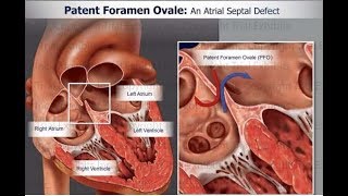 Patent foramen ovale PFO Part II [upl. by Idnas]