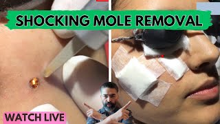 Watch This Shocking Mole Removal live  Wart Removal  moleremoval [upl. by Pellet824]