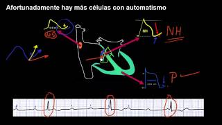 BLOQUEO AV COMPLETO [upl. by Eanore]