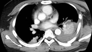 Pulmonary hemorrhage A Ahuja AT et al 2017 Book Essential Radiology [upl. by Oxley]