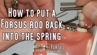 How to repair a Forsus with braces BY YOURSELF [upl. by Maidel]