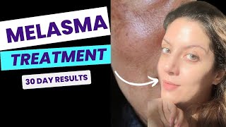 How to remove Melasma at home  Visible results in 30 days  Full AM PM routine to treat Melasma [upl. by O'Gowan]