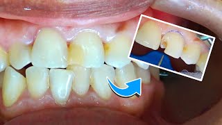 Reconstruccion diente con caries [upl. by Ohnuj]