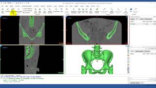 How to Use RegionGrowing in Mimics  Mimics Innovation Suite  Materialise Medical [upl. by Ashelman348]