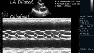 DILATED CARDIOMYOPATHY DCMP  ECHOCARDIOGRAPHY SERIES BY DR ANKUR K CHAUDHARI [upl. by Gehlbach]