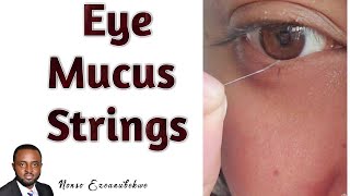 Eye Mucus Strings  Mucus Fishing Syndrome  Causes and Treatment [upl. by Leizahaj384]