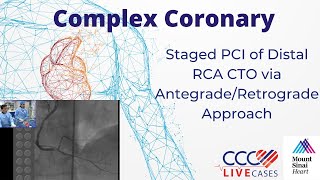 Staged PCI of Distal RCA CTO via AntegradeRetrograde Approach  September 16 2014 Webcast [upl. by Ojyllek]