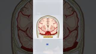 Subarachnoid hemorrhage is the result of a brain aneurysm brain brainbleed doctor medical [upl. by Eerual]