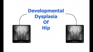 Developmental dysplasia of hip [upl. by Glory]