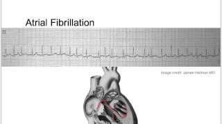 Tachycardia Basic Discussion [upl. by Ogaitnas]