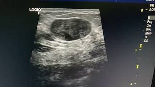 Fibroadenoma breast ultrasound  BIRADS 3  Probably Benign [upl. by Arraet]