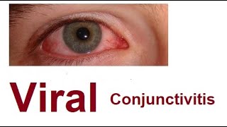 Viral Conjunctivitis [upl. by Rask]