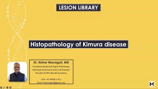 Histopathology of Kimura disease [upl. by Eilram]