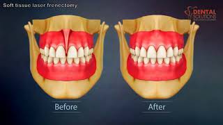 Soft tissue laser frenectomy for reducing gap between teeth [upl. by Sergeant]