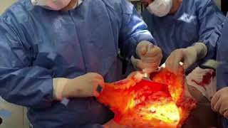 Abdominoplastia Dr Hernando Tenorio [upl. by Anaya]