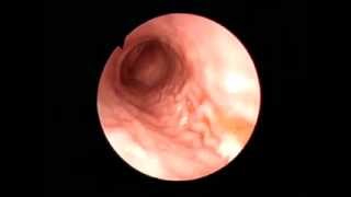 Gastroscopy Erosive antral gastritis [upl. by Aettam]