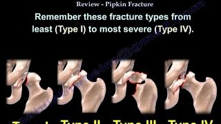 Femoral Head Fracture Review Pipken Fracture  Everything You Need To Know  Dr Nabil Ebraheim [upl. by Nosaes]