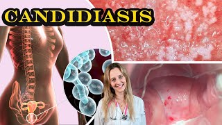 CANDIDIASIS VAGINAL CAUSAS SÍNTOMAS DIAGNÓSTICO Y TRATAMIENTO  Dra Aperpin [upl. by Panayiotis]